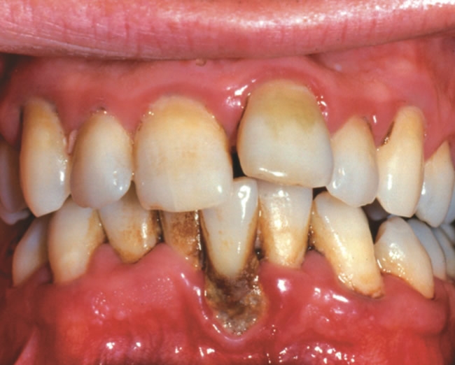 lead line gums