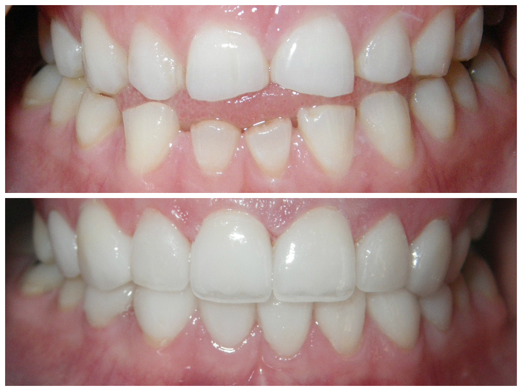 Before and after pictures of Veneers - LA Dental Clinic