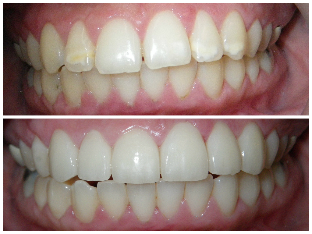 Before and after pictures of Veneers - LA Dental Clinic