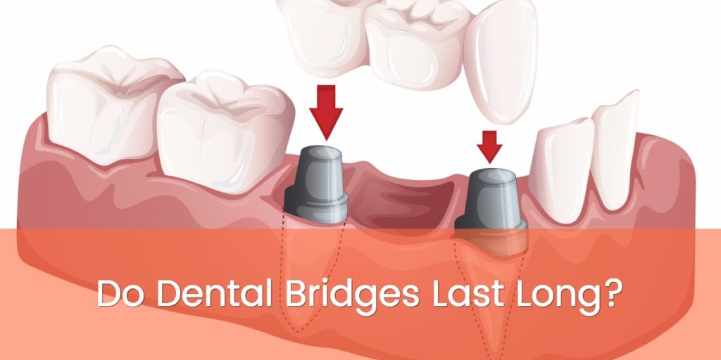 do dental bridges last long