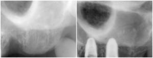 x-ray of bone graft