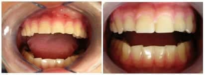 teeth with dental bonding before and after