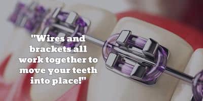 wire and brackets on braces