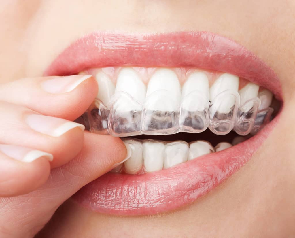 woman holding invisalign up to her teeth