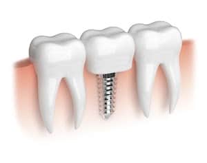 diagram of dental implants 